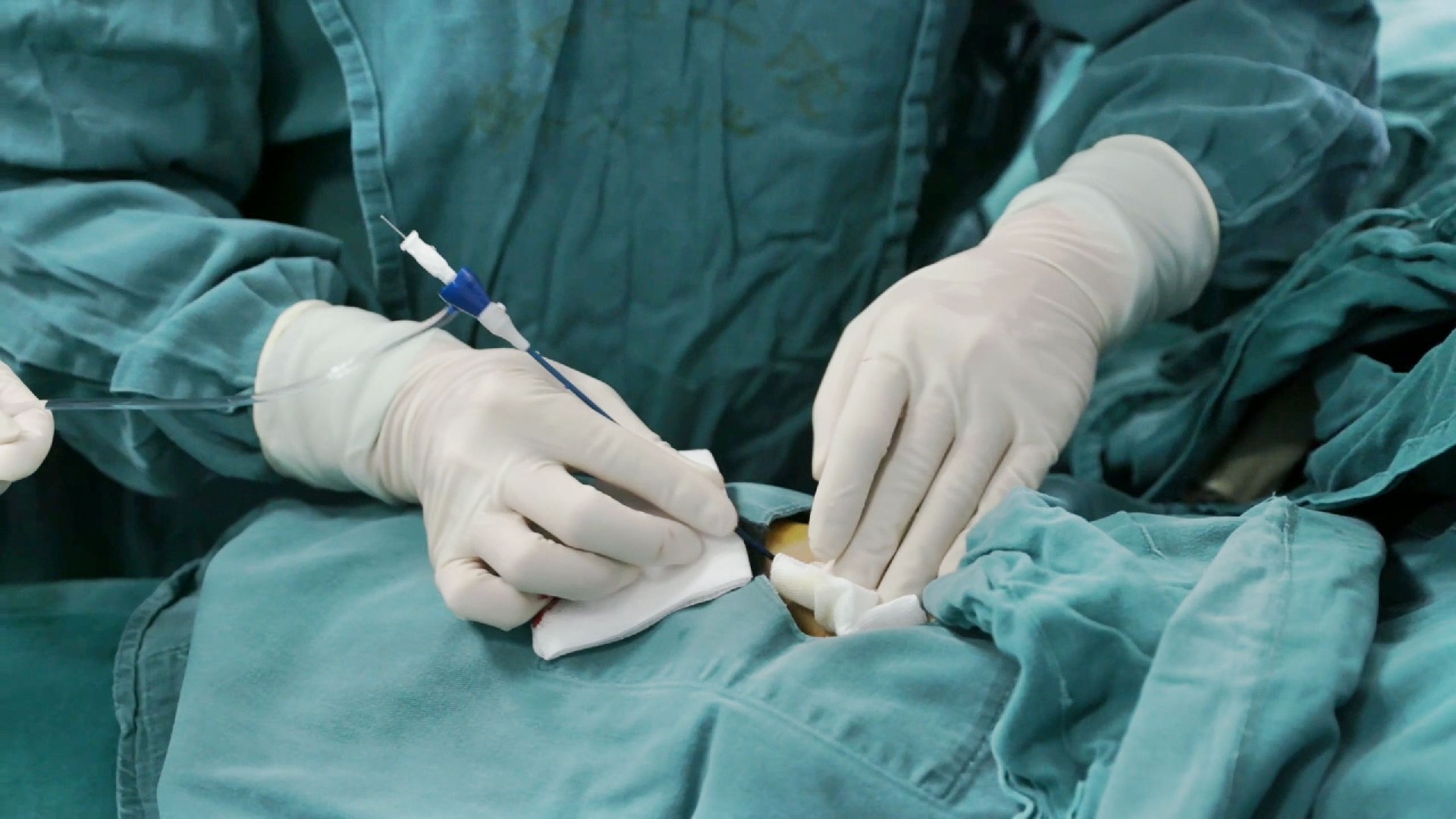 Procedimiento intervencionista para el cáncer de células hepáticas por abordaje radial
