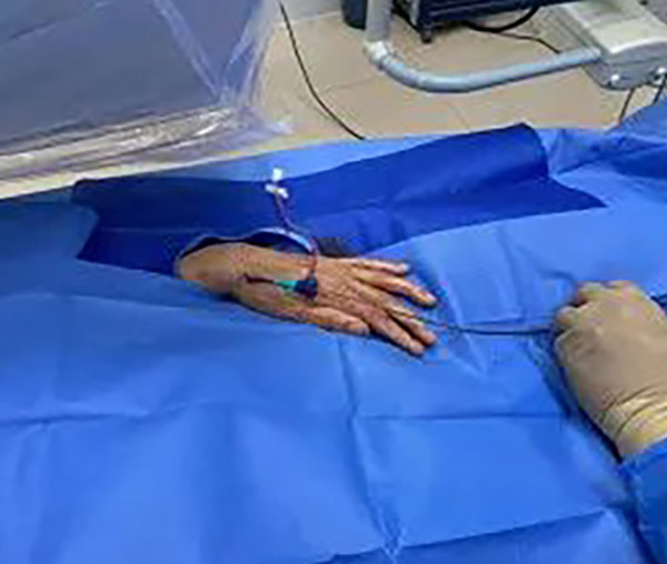 Trombectomía mecánica percutánea para embolia aguda de la arteria mesentérica superior a través de acceso transradial distal izquierdo en la tabaquera anatómica.